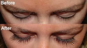 Bimatoprosta Sobrancelha Antes E Depois - LATISSE (Bimatoprosta): Como funciona? Preço e resultados!