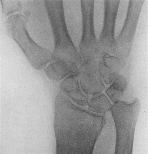 Essex Lopresti Fracture LITFL Medical Eponym Library