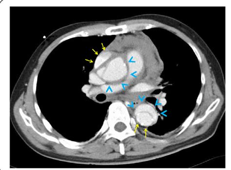 Computed Tomography With Contrast Enhancement In A Patient With Acute