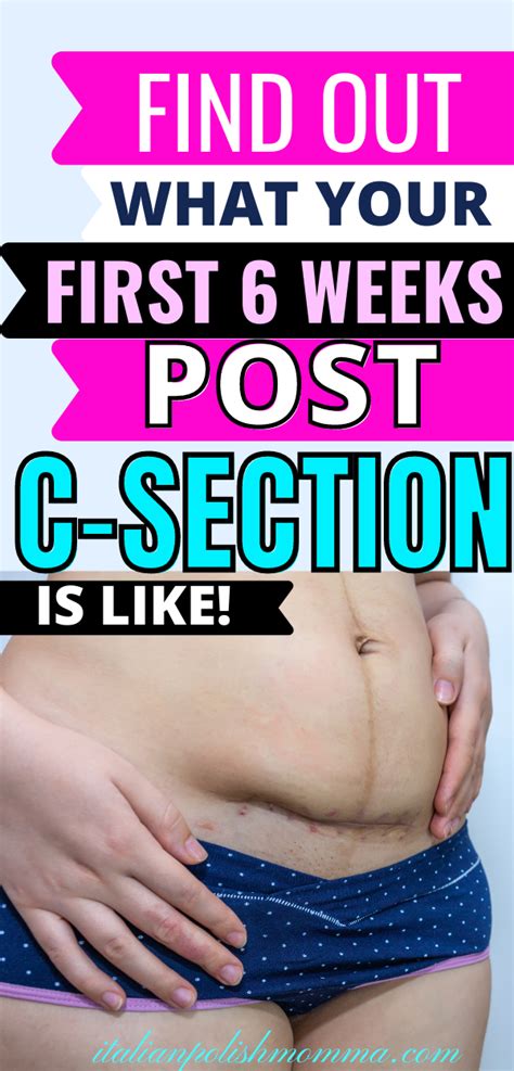 C Section Recovery Timeline Artofit