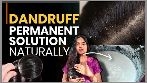 Dandruff Treatment At Home Dandruff Removal 100 Percent Solution For Dandruff ☑️☑️ Youtube