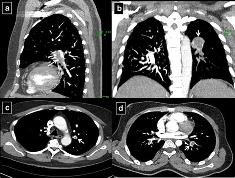 A Sagittal Reconstruction Computed Tomography Pulmonary Angiography