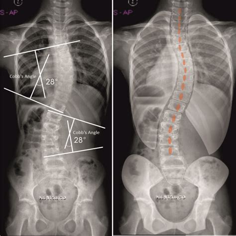 scoliosis types treatments chiropractic benefits
