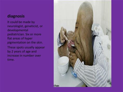 PPT - Neurofibromatosis PowerPoint Presentation, free download - ID:6802014