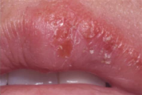 Recurrent Herpes Labialis News Dentagama