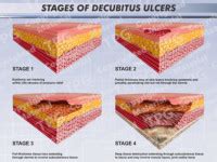 Stages of Decubitus Ulcers - Order