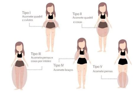 Como Feita A Lipoaspira O No Joelho E Quem Pode Faz La Entenda