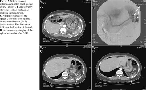 A Spleen Contrast Extravasation After Blunt Splenic Injury Arrows B