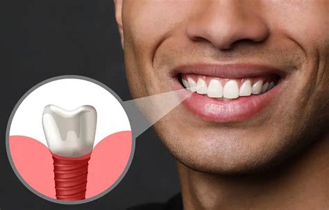 How To Care For Your Dental Implants Creative Dental Of Queens Rego