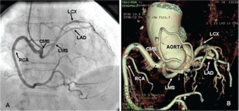 coronary angiography left anterior oblique view cms common main