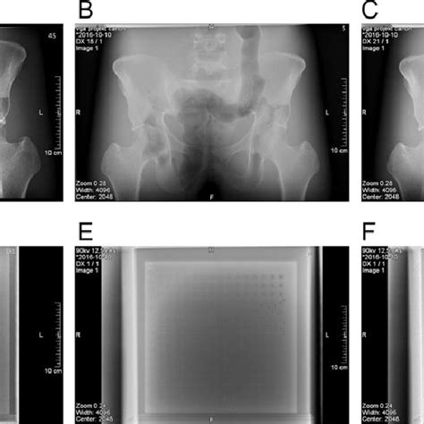 A Anthropomorphic Reference Image 75 Kv And 16 Mas B Pelvic Download Scientific Diagram