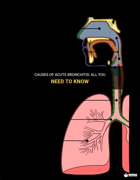 Causes Of Acute Bronchitis: All You Need To Know | MedShun