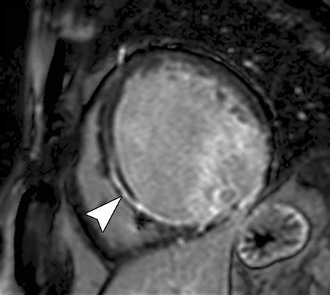 Metal Artifact Reduction In Cardiovascular Mri For Accurate Myocardial