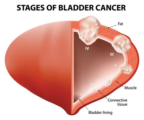 Bladder Cancer - DiseasesAndConditions.net