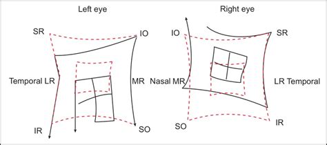 superior oblique palsy diplopia charting