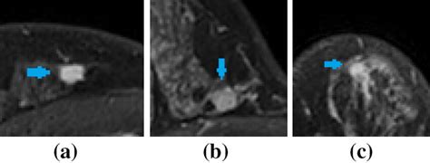 Example images of different types of lesion: a common isolated lesion ...