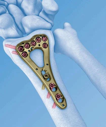 Variable Angle Distal Radius LCP Plate At 4000 LCP Plates In