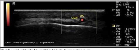 Greater Occipital Nerve Block Ultrasound