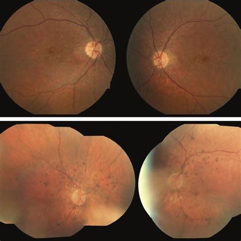 A Fundus Photographs Of Case 1 Showing Retinal Pigment Epithelium