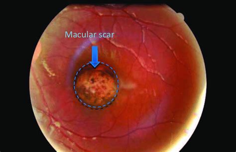 Characteristic Toxoplasmic Retinochoroidal Damage Atrophic