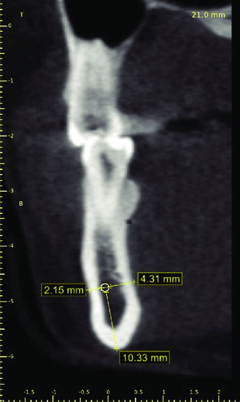 Linear Measurements Of The Distances Between The Mandibular Incisive