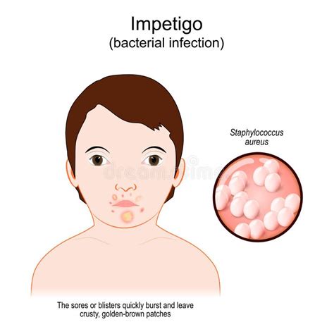 Impetigo Bébé Visage Avec Infection De La Peau Illustration de Vecteur