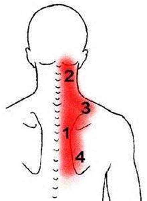 Treating a neck muscle strain - Muscle Pull | Muscle Pull