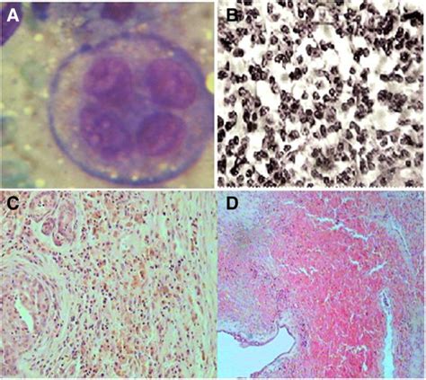 Evaluation Of Accuracy Of Fine Needle Aspiration Cytology And