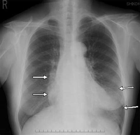 Chest Radiograph Shows An Unclear Shadow In The Right Lung Hilum And