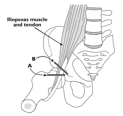 Iliopectineal Eminence Snapping Hip