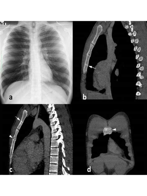 Stress Fracture of the Sternum in Case Dealing With the Wrestling Sport ...