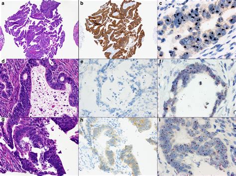 Erbb2 Immunohistochemistry And Chromogenic In Situ Hybridization