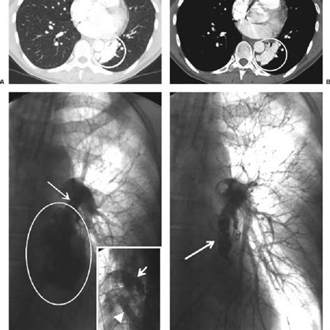 Vascular Intervention In Pulmonary Critical Care Embolization Of