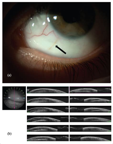 Multiple XEN Gel Stents For Refractory Pediatric Glaucoma Journal Of