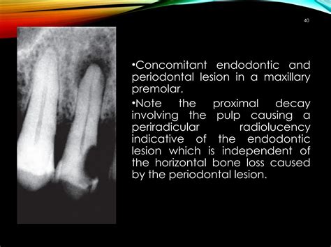 Endo Perio Lesions Diagnosis And Management Ppt