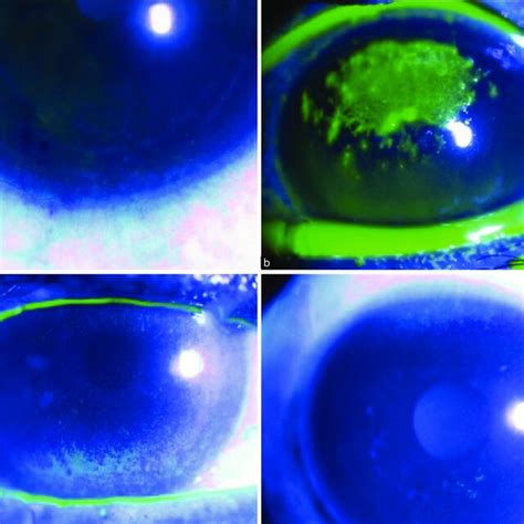 A Punctate Corneal Staining Demonstrated Using Fluorescein Dye And Download Scientific