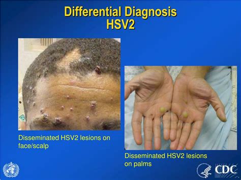 Ppt Evaluating Patients With Acute Generalized Vesicular Or Pustular Rash Illnesses Powerpoint