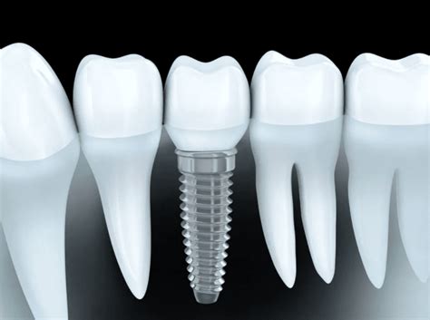 Dental Implants Southern Dental