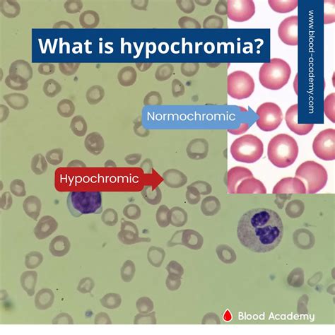 1/ What is hypochromia and more…a short thread 🧵 - Thread from Blood ...