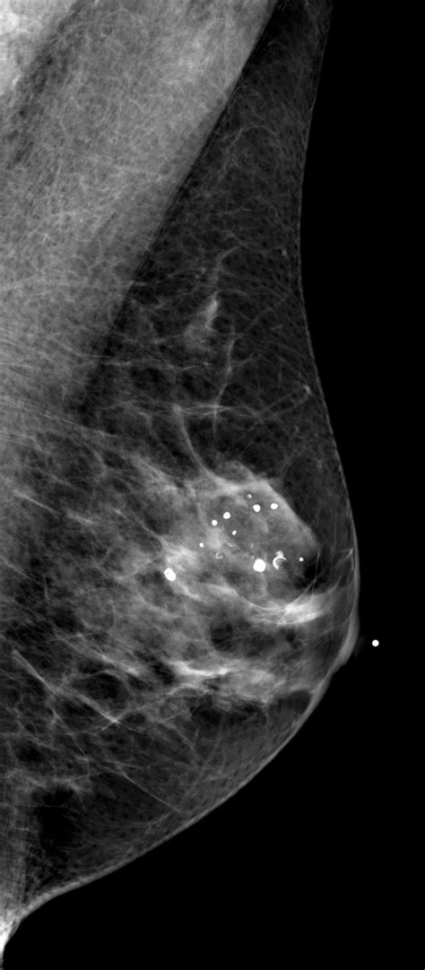 Segmental Breast Calcifications AJR