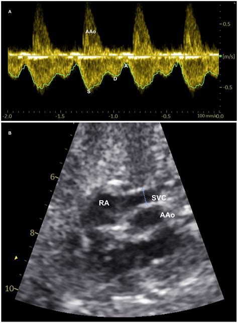 Measurement Of Superior Vena Cava Svc Blood Flow A Spectral