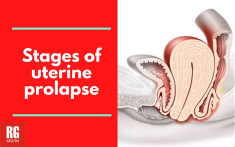 Stages Of Uterine Prolapse