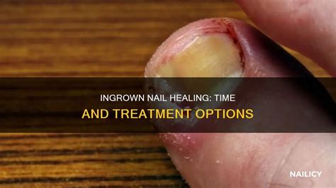 how long does it take an ingrown hair to heal