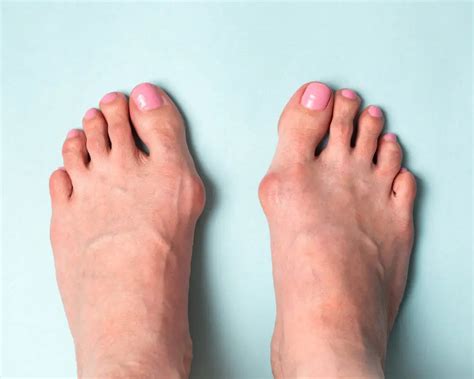 Hallux Rigidus Symptoms And Causes Liebscher And Bracht