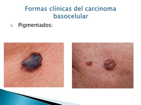 Carcinoma Basocelular Y Espinocelular Ppt