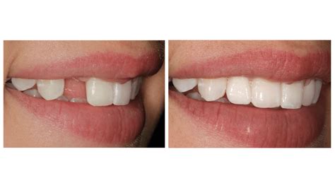 Palmetto Dental Associates — Missing Lateral Incisors