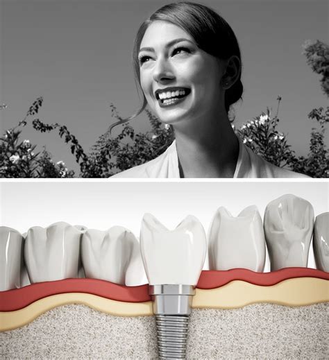 Dental Implants In Beverly Hills Los Angeles Ca