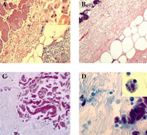 Mycobacterium Ulcerans Toxic Macrolide Mycolactone Modulates The Host