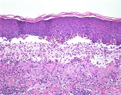 Pathology Outlines - Coma blister