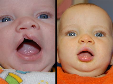 Incomplete Cleft Lip Correction Surgery Child With Right S Flickr